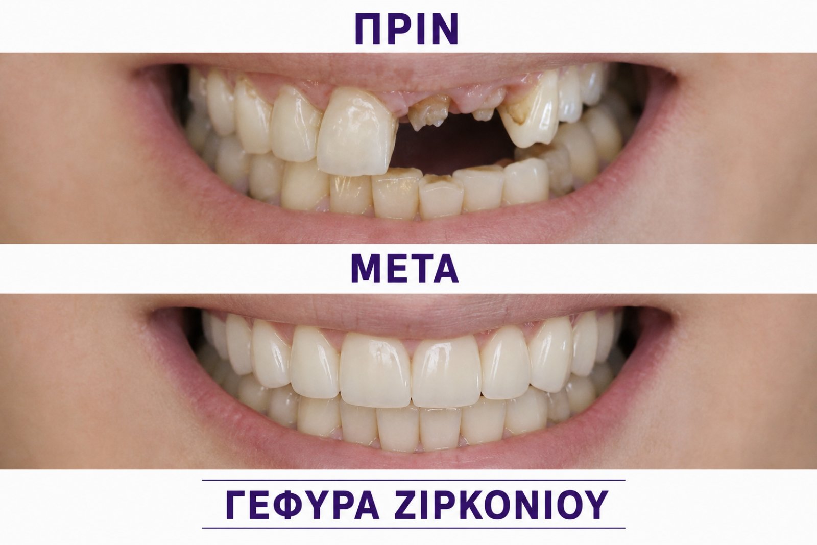Γέφυρα ζιρκονίου — τέταρτο περιστατικό πριν