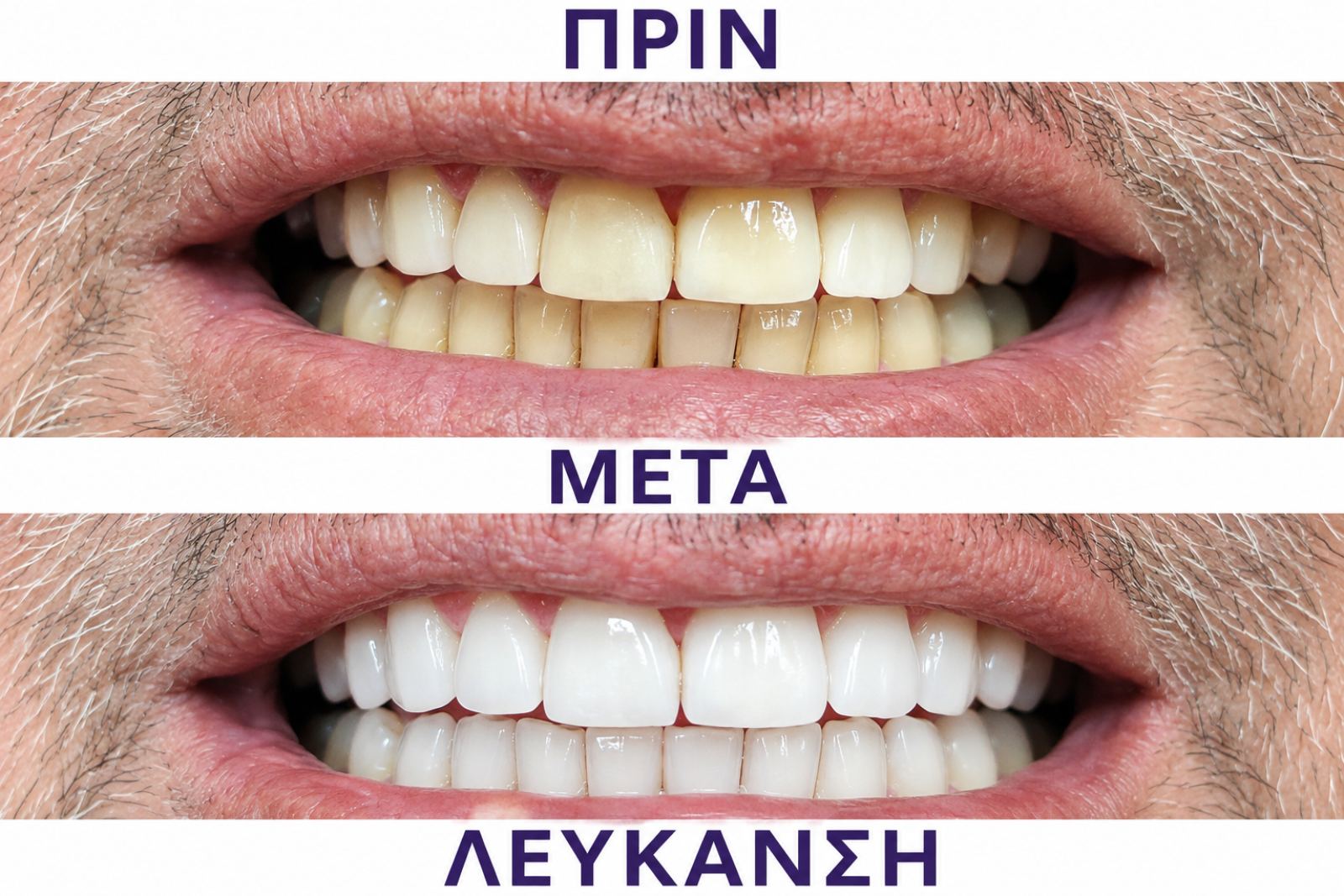 Λεύκανση δοντιών — δεύτερο περιστατικό πριν