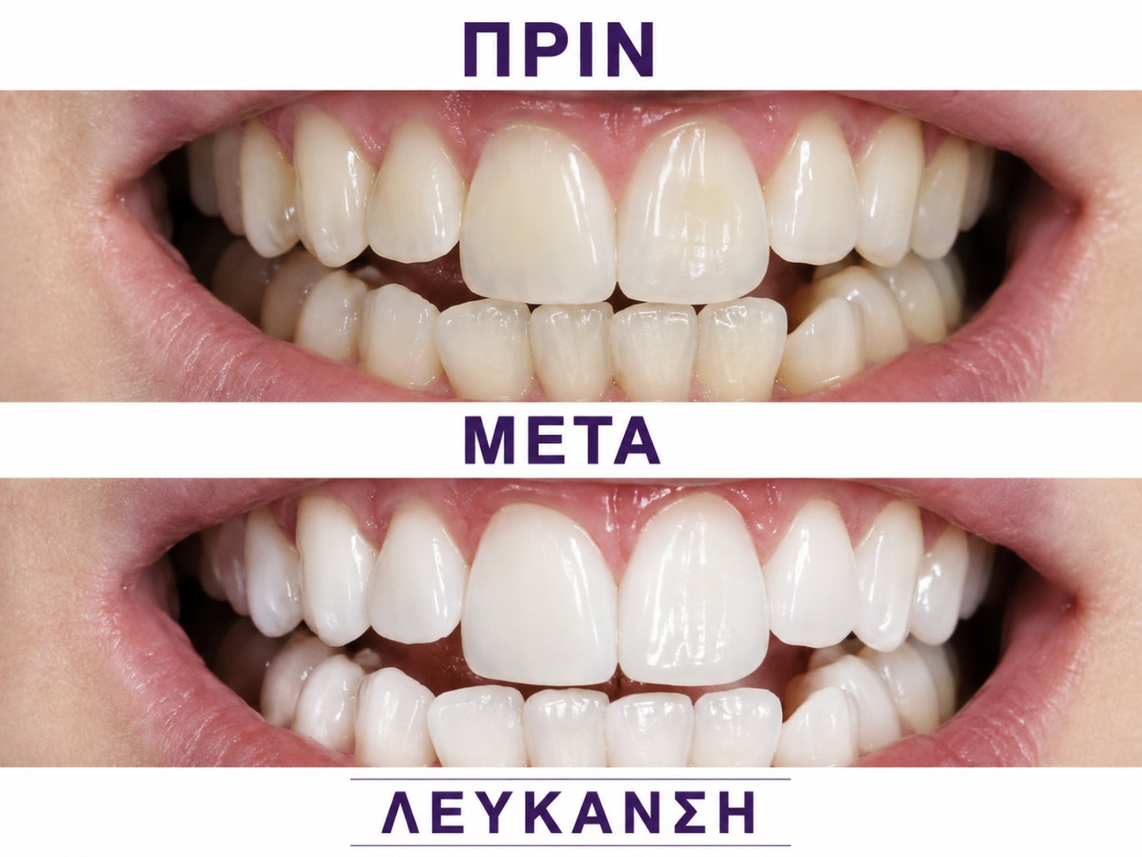 Λεύκανση δοντιών — τρίτο περιστατικό πριν