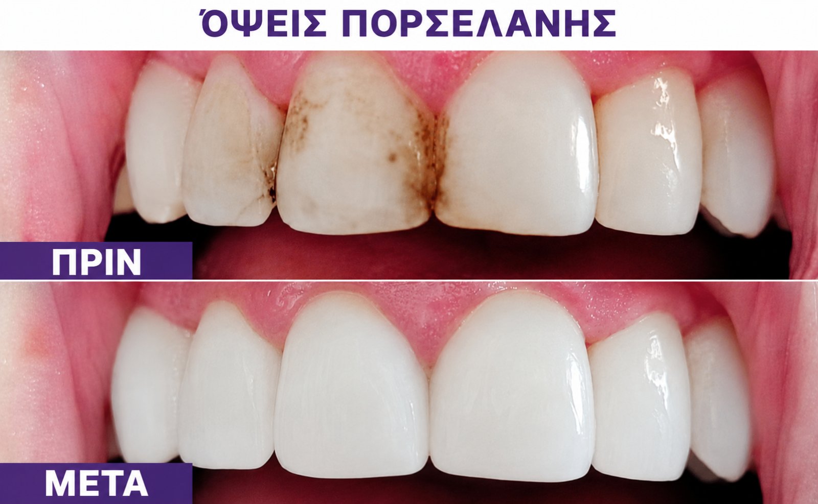 Όψεις πορσελάνης — δεύτερο περιστατικό πριν